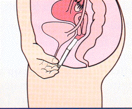 protections féminines (règles chez les filles, tampons, serviettes hygiéniques) ~ Pediatre Online